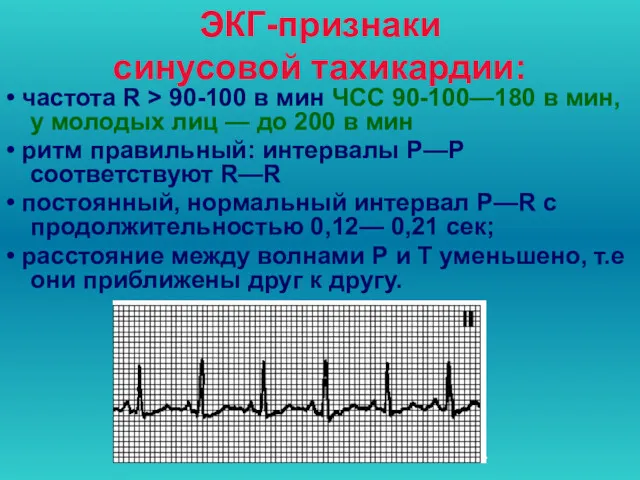 ЭКГ-признаки синусовой тахикардии: • частота R > 90-100 в мин