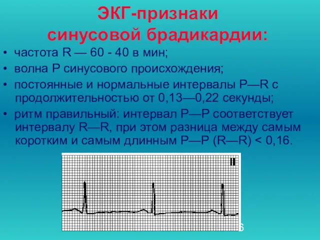 ЭКГ-признаки синусовой брадикардии: • частота R — 60 - 40