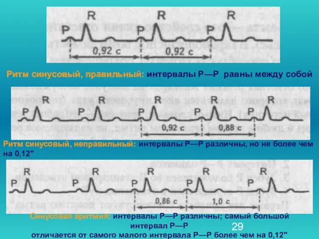Ритм синусовый, правильный: интервалы Р—Р равны между собой Ритм синусовый,