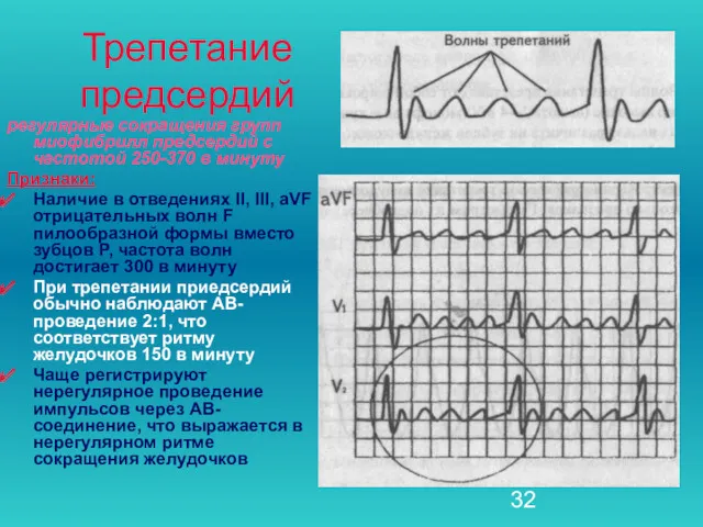 Трепетание предсердий регулярные сокращения групп миофибрилл предсердий с частотой 250-370