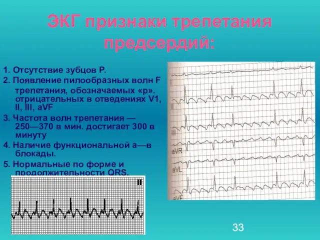 ЭКГ признаки трепетания предсердий: 1. Отсутствие зубцов Р. 2. Появление