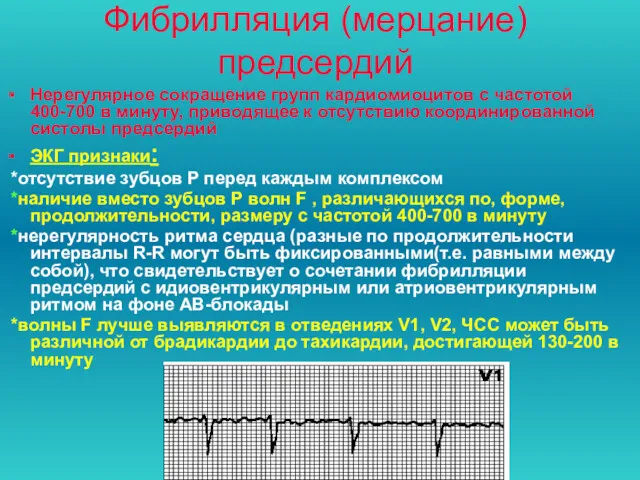 Фибрилляция (мерцание) предсердий Нерегулярное сокращение групп кардиомиоцитов с частотой 400-700