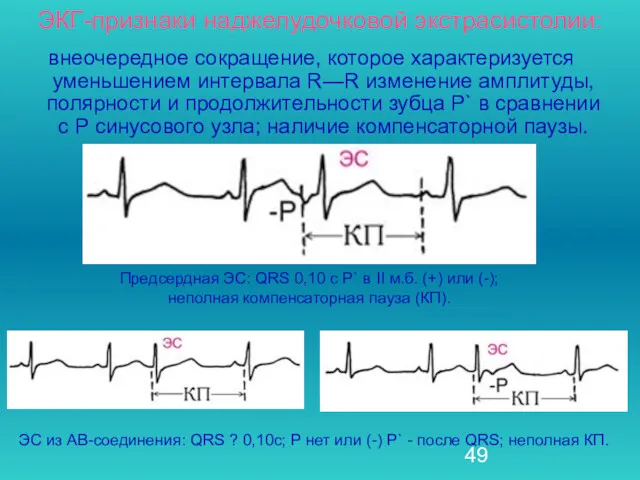 внеочередное сокращение, которое характеризуется уменьшением интервала R—R изменение амплитуды, полярности