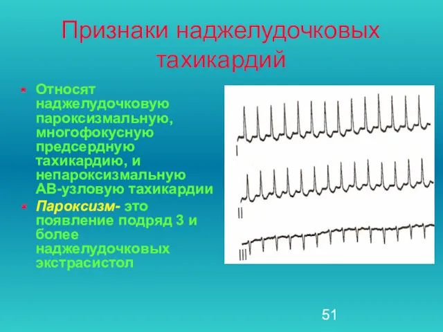 Признаки наджелудочковых тахикардий Относят наджелудочковую пароксизмальную, многофокусную предсердную тахикардию, и