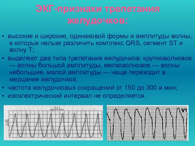 ЭКГ-признаки трепетания желудочков: • высокие и широкие, одинаковой формы и