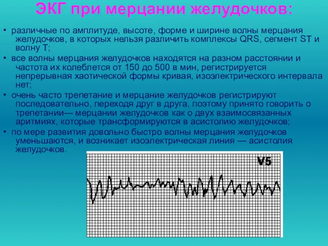 ЭКГ при мерцании желудочков: • различные по амплитуде, высоте, форме