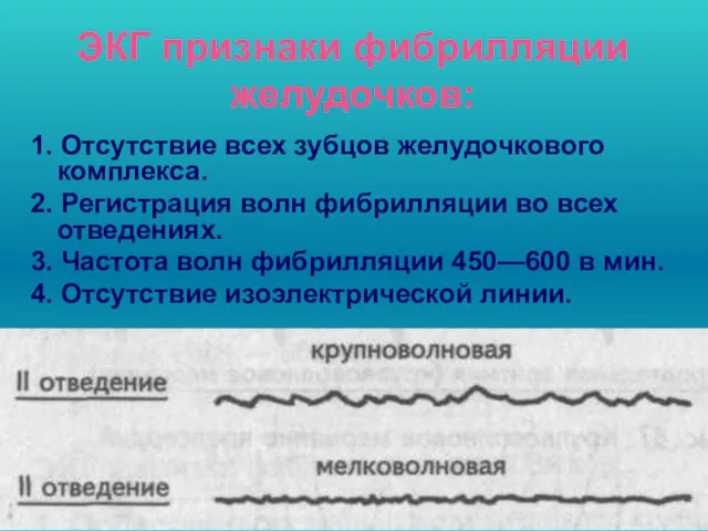 ЭКГ признаки фибрилляции желудочков: 1. Отсутствие всех зубцов желудочкового комплекса.