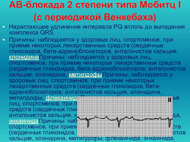 АВ-блокада 2 степени типа Мобитц I (с периодикой Венкебаха) Нарастающее