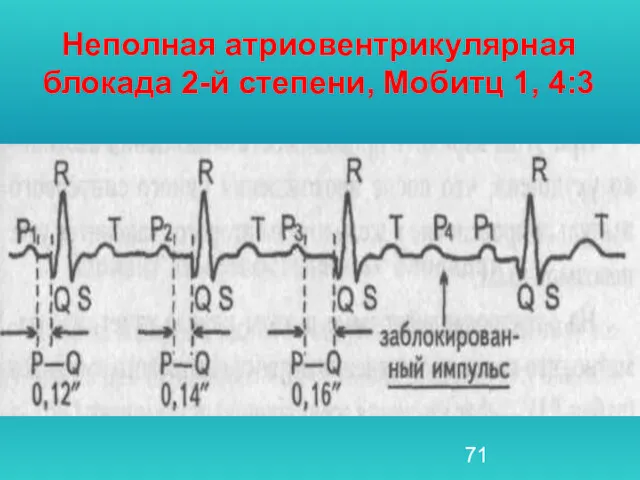 Неполная атриовентрикулярная блокада 2-й степени, Мобитц 1, 4:3