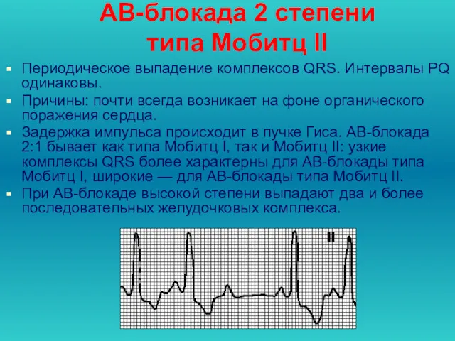 АВ-блокада 2 степени типа Мобитц II Периодическое выпадение комплексов QRS.