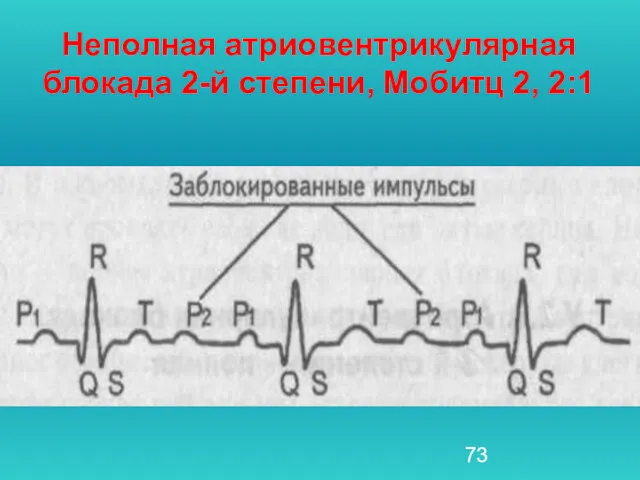 Неполная атриовентрикулярная блокада 2-й степени, Мобитц 2, 2:1