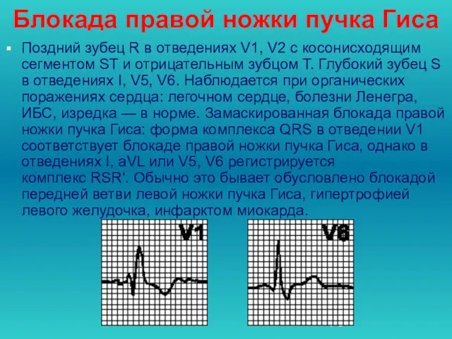 Блокада правой ножки пучка Гиса Поздний зубец R в отведениях