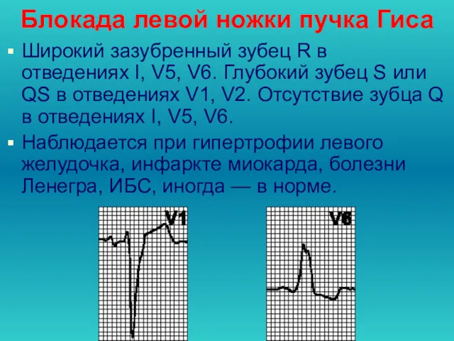 Блокада левой ножки пучка Гиса Широкий зазубренный зубец R в