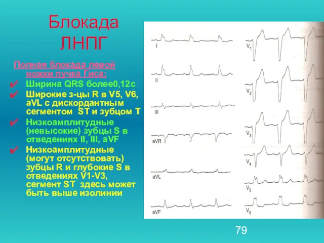 Блокада ЛНПГ Полная блокада левой ножки пучка Гиса: Ширина QRS