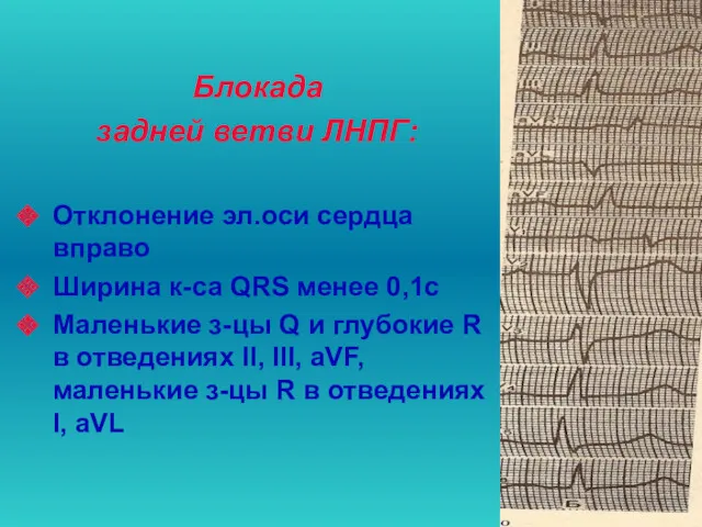 Блокада задней ветви ЛНПГ: Отклонение эл.оси сердца вправо Ширина к-са