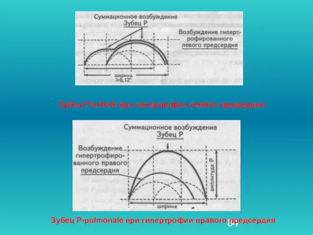 Зубец Р-mitrale при гипертрофии левого предсердия Зубец Р-pulmonale при гипертрофии правого предсердия
