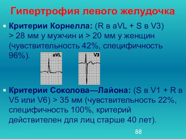 Гипертрофия левого желудочка Критерии Корнелла: (R в aVL + S