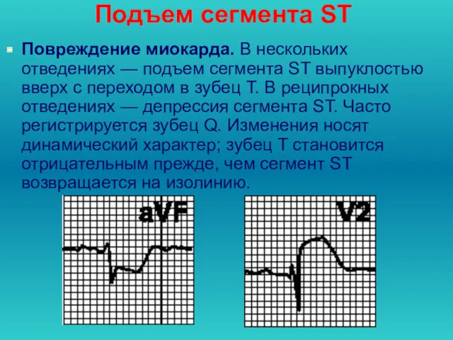 Подъем сегмента ST Повреждение миокарда. В нескольких отведениях — подъем