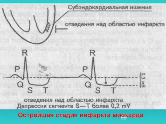 Острейшая стадия инфаркта миокарда