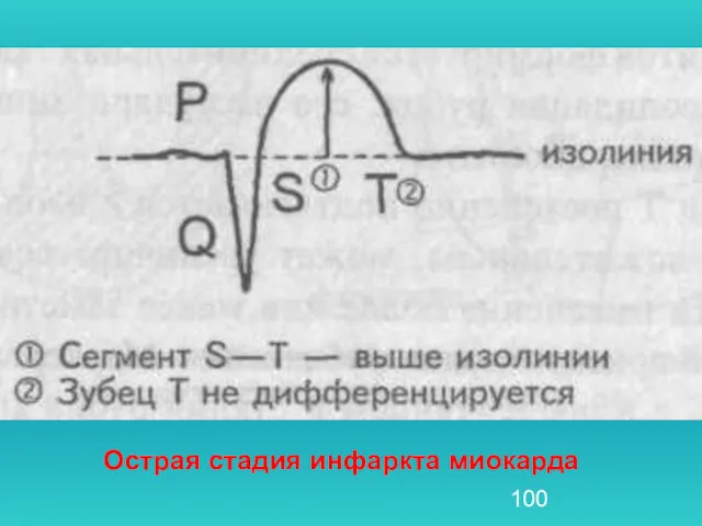 Острая стадия инфаркта миокарда