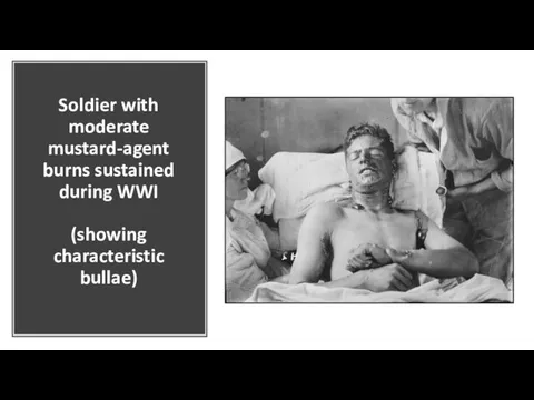 Soldier with moderate mustard-agent burns sustained during WWI (showing characteristic bullae)