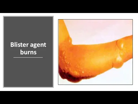 Blister agent burns