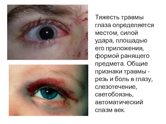 Тяжесть травмы глаза определяется местом, силой удара, площадью его приложения, формой ранящего предмета.
