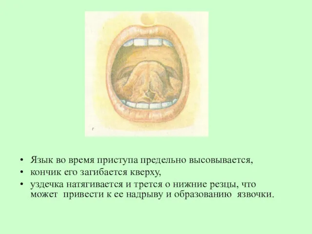 Язык во время приступа предельно высовывается, кончик его загибается кверху,