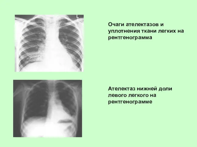 Очаги ателектазов и уплотнения ткани легких на рентгенограмма Ателектаз нижней доли левого легкого на рентгенограмме