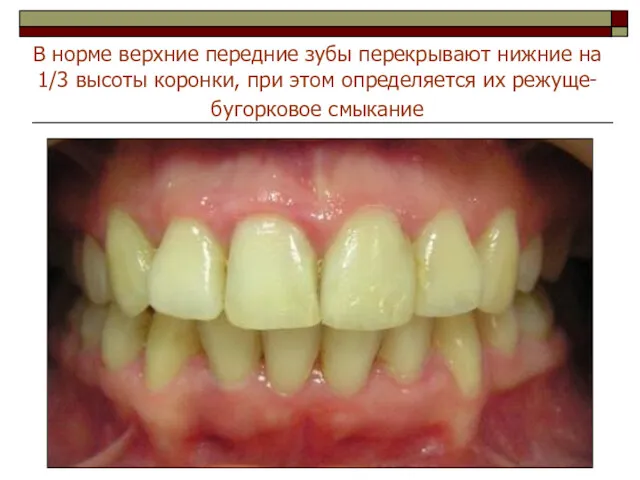 В норме верхние передние зубы перекрывают нижние на 1/3 высоты