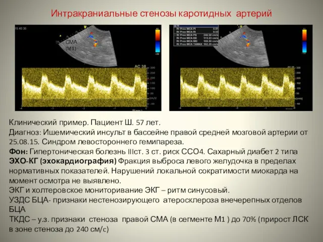 Интракраниальные стенозы каротидных артерий СМА (M1) Клинический пример. Пациент Ш.