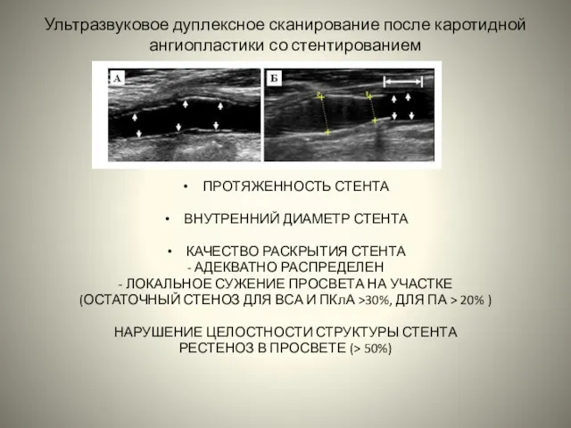 Ультразвуковое дуплексное сканирование после каротидной ангиопластики со стентированием ПРОТЯЖЕННОСТЬ СТЕНТА