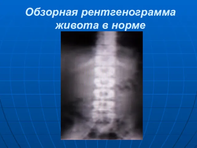 Обзорная рентгенограмма живота в норме