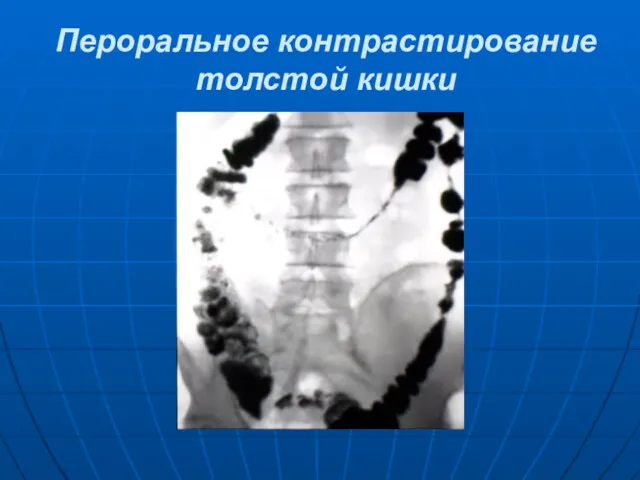 Пероральное контрастирование толстой кишки