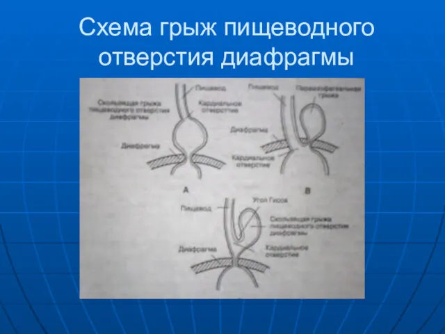 Схема грыж пищеводного отверстия диафрагмы