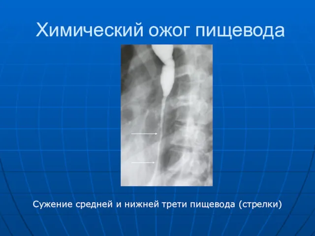 Химический ожог пищевода Сужение средней и нижней трети пищевода (стрелки)