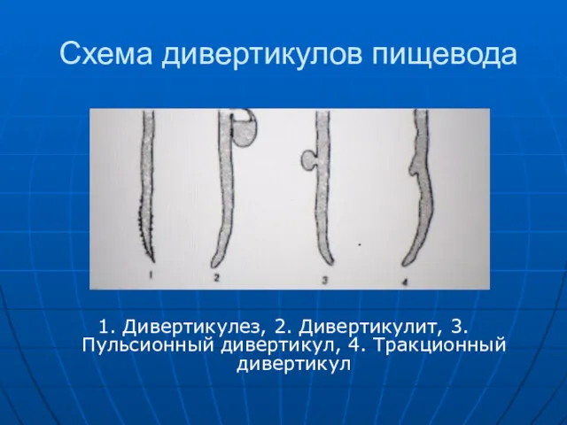 Схема дивертикулов пищевода 1. Дивертикулез, 2. Дивертикулит, 3. Пульсионный дивертикул, 4. Тракционный дивертикул