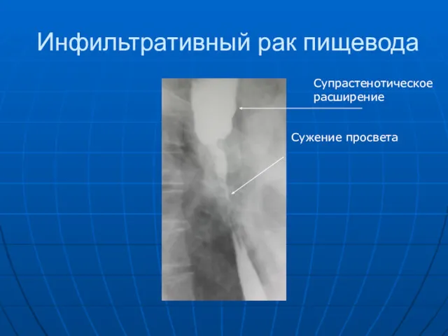 Инфильтративный рак пищевода Сужение просвета Супрастенотическое расширение