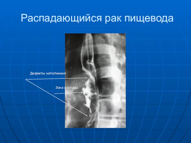 Распадающийся рак пищевода Зона распада Дефекты наполнения