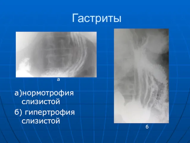 Гастриты а)нормотрофия слизистой б) гипертрофия слизистой а б