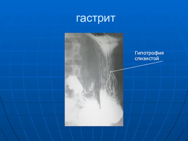 гастрит Гипотрофия слизистой