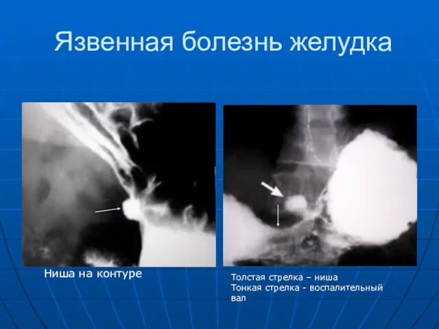 Язвенная болезнь желудка Ниша на контуре Толстая стрелка – ниша Тонкая стрелка - воспалительный вал