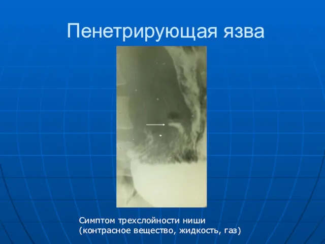 Пенетрирующая язва Симптом трехслойности ниши (контрасное вещество, жидкость, газ)