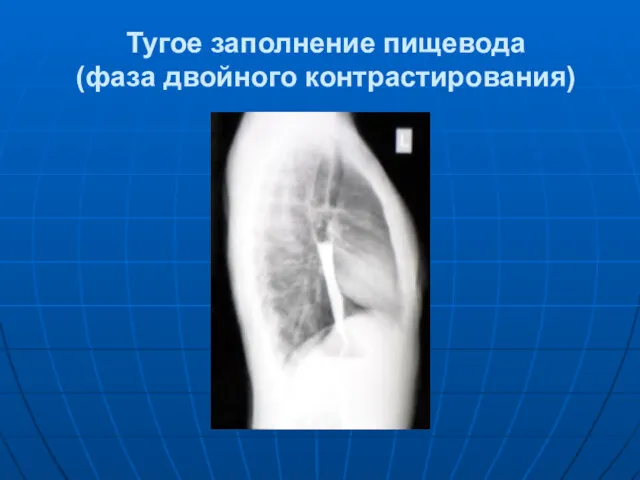 Тугое заполнение пищевода (фаза двойного контрастирования)