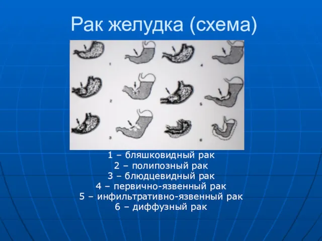 Рак желудка (схема) 1 – бляшковидный рак 2 – полипозный