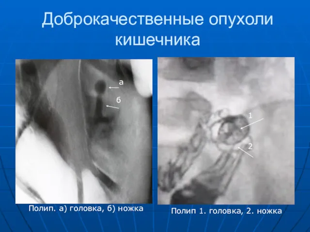 Доброкачественные опухоли кишечника а б 1 2 Полип. а) головка,