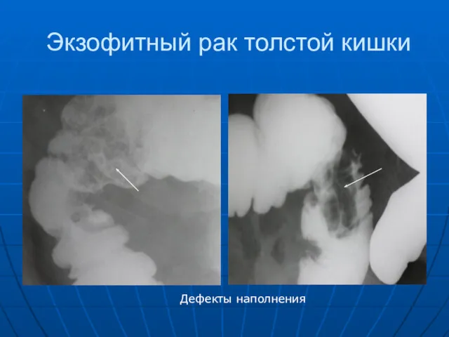 Экзофитный рак толстой кишки Дефекты наполнения