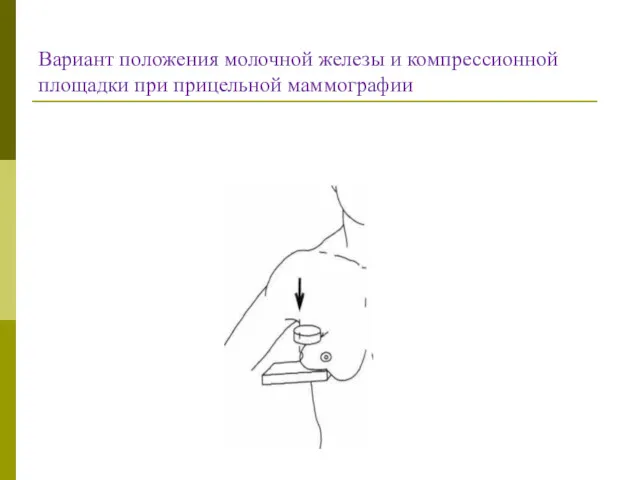 Вариант положения молочной железы и компрессионной площадки при прицельной маммографии