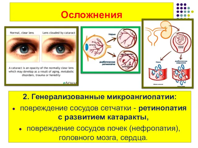Осложнения 2. Генерализованные микроангиопатии: повреждение сосудов сетчатки - ретинопатия с развитием катаракты, повреждение