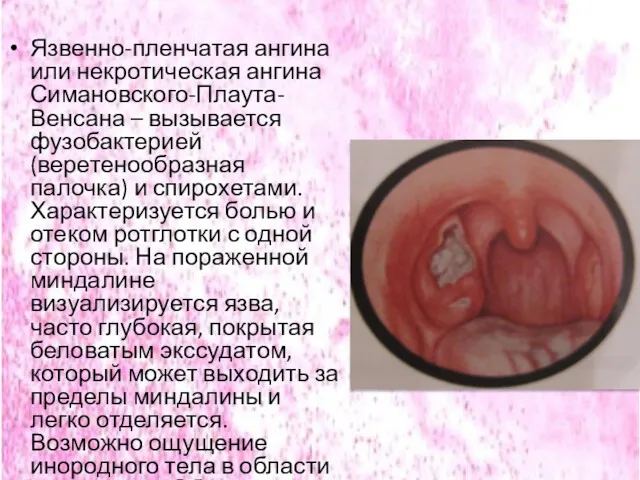 Язвенно-пленчатая ангина или некротическая ангина Симановского-Плаута-Венсана – вызывается фузобактерией (веретенообразная